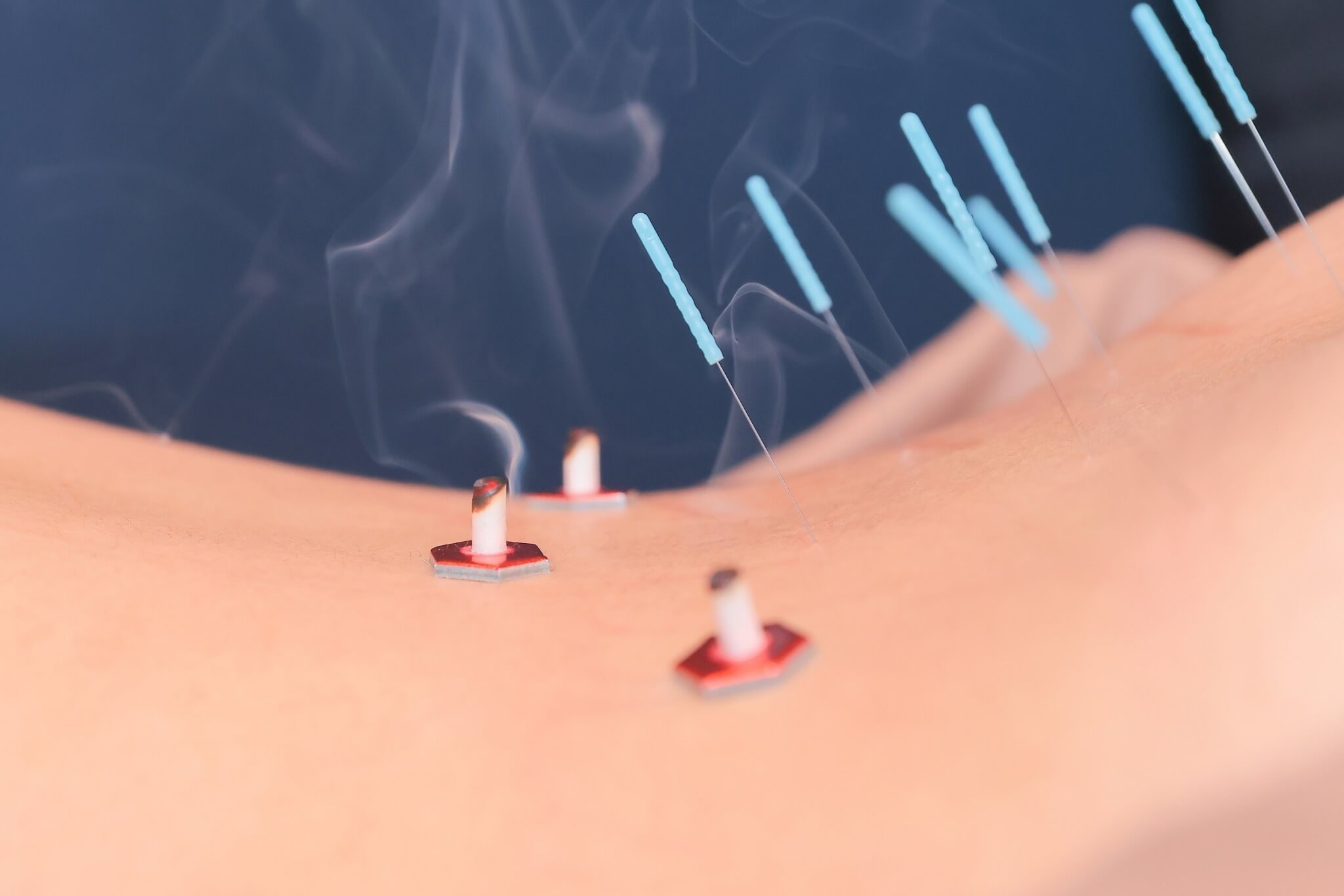 鍼灸イメージ|慢性胃腸炎「下痢」